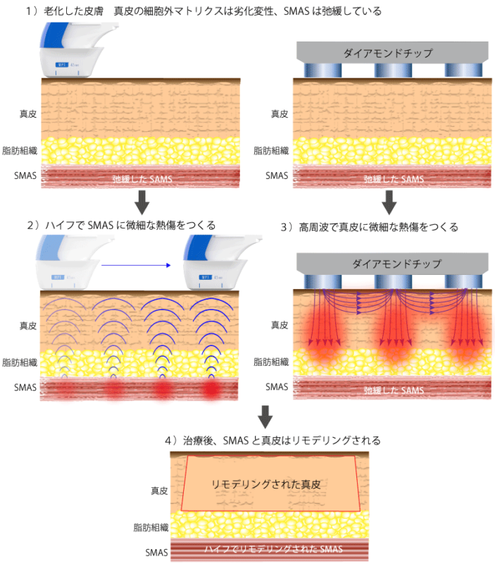 ポテンツァダイヤモンドチップとウルトラフォーマーMPTの作用の違い