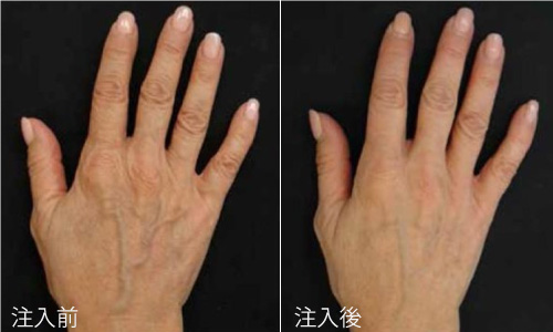 プロファイロを手背に注入した症例写真