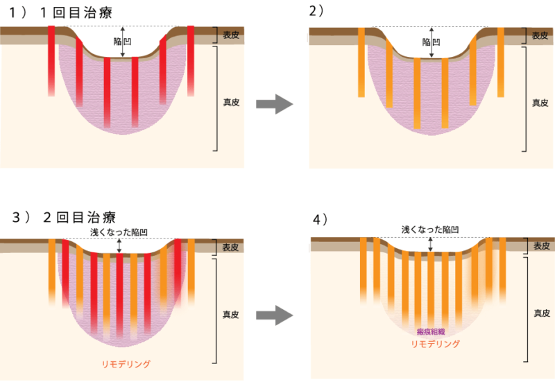 1540フラクショナルレーザーの作用機序