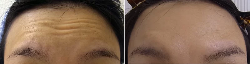 ボトックスによる治療写真（額）