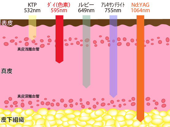 レーザー波長と深達度595nmと1064nmの違い