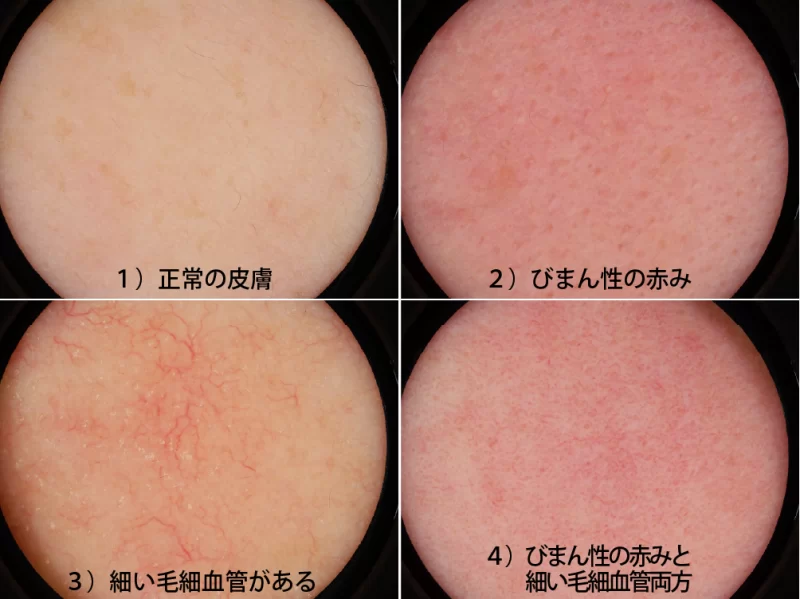 ダーモスコピー写真の特徴