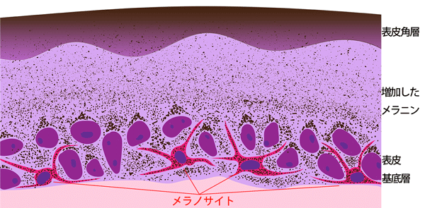 扁平母斑でメラノサイト