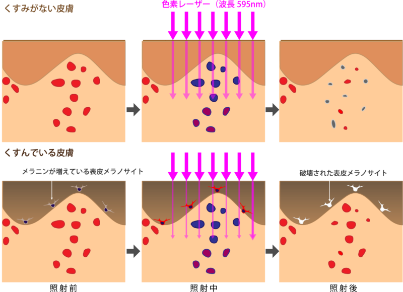 くすんだ皮膚では色素レーザーは効かない理由（図）