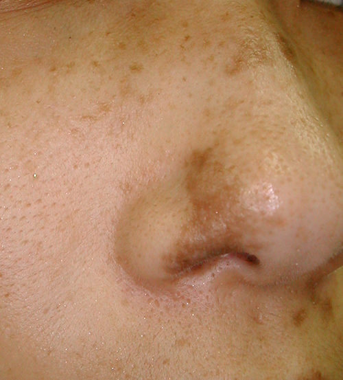 鼻孔の太田母斑