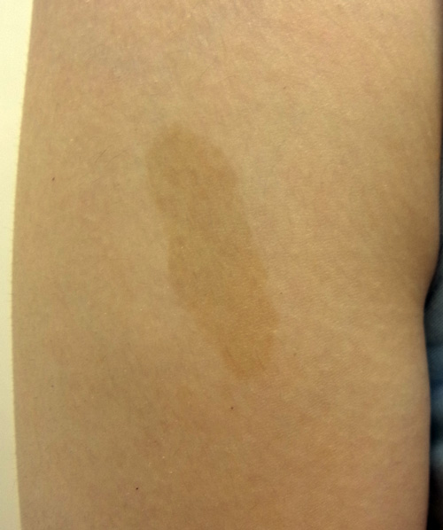 扁平母斑の写真（腕）