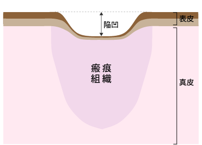瘢痕を形成した状態