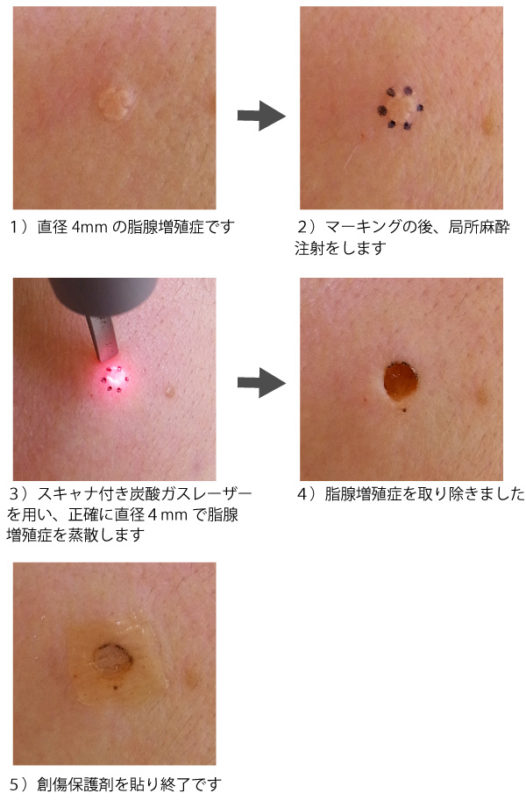 脂腺増殖症レーザー治療の過程