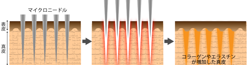 ダーマペンの採用機序の図