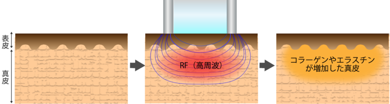 RFの採用機序の図