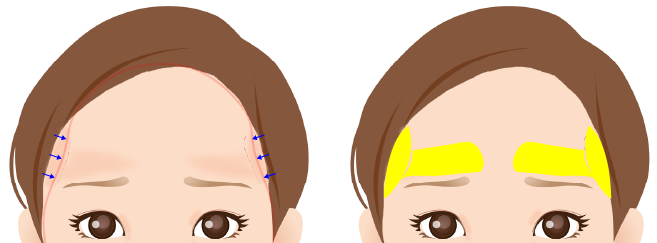 額のヒアルロン酸注入図
