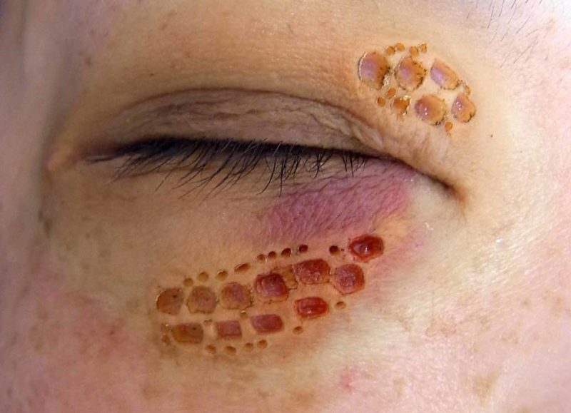 大きい眼瞼黄色腫の治療例