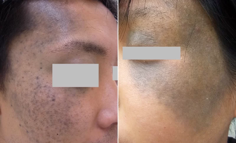 典型的太田母斑