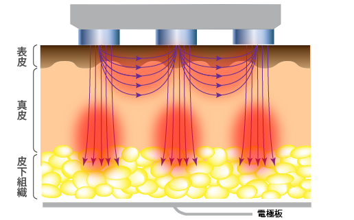 ダイヤモンドチップでは「モノポーラ」と「バイポーラ」の照射の様子