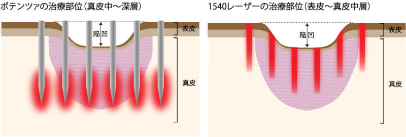 ポテンツァと1540フラクショナルレーザーの治療効果の違い