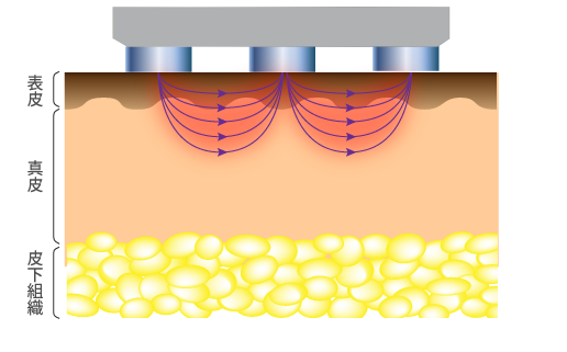 バイポーラでの高周波（RF）の皮膚の中での流れ