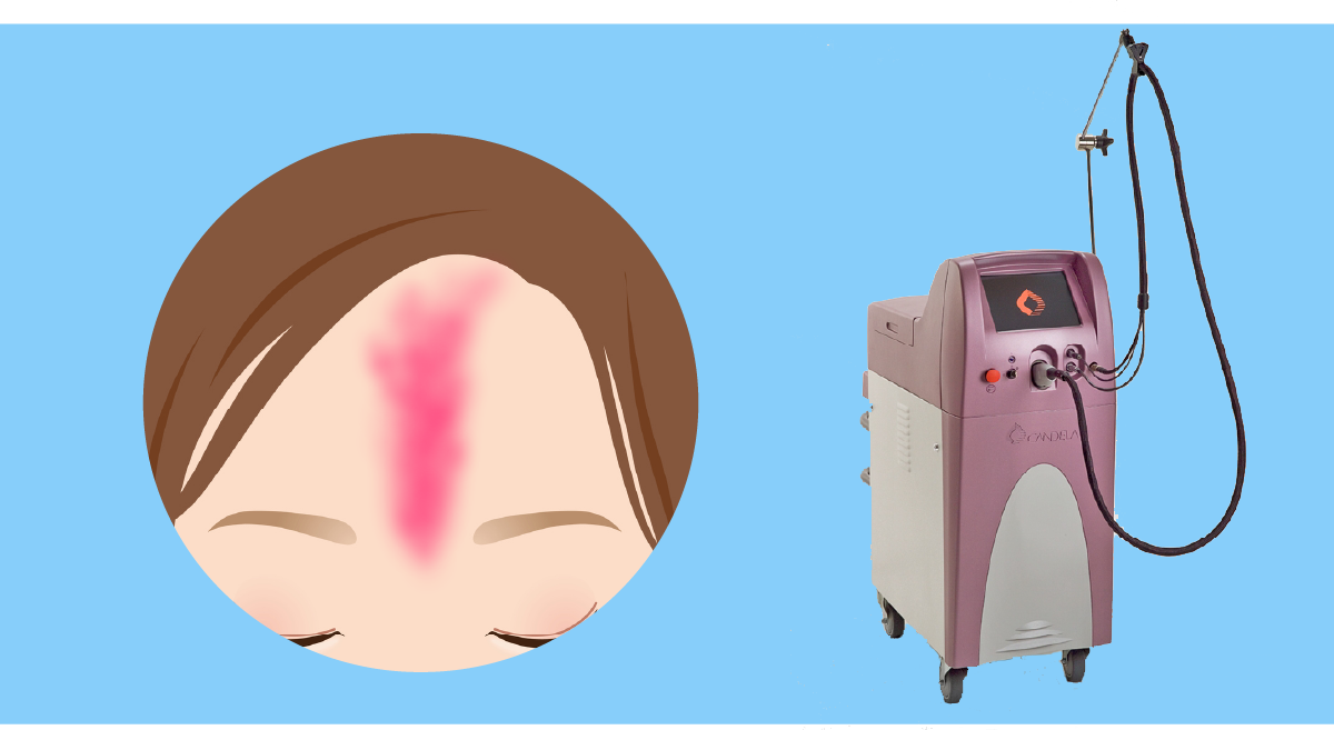 サーモンパッチ ｜新宿 高田馬場の皮膚科・美容皮膚科「山手皮膚科