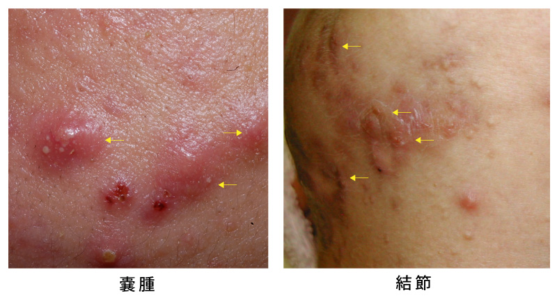 にきび(嚢腫、接結)