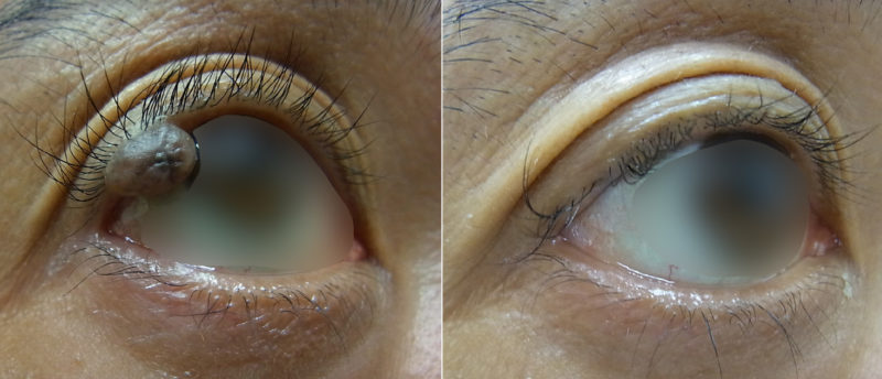 上眼瞼ほくろ治療前後