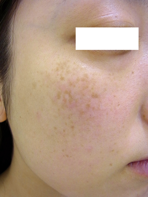 ソバカスのように見えるADM