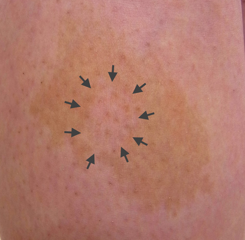 地図上の扁平母斑のレーザーテスト照射後の写真