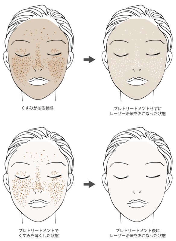 フォトフェイシャルによるプレトリートメントの図