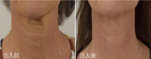 プロファイロを頸部に注入した症例写真