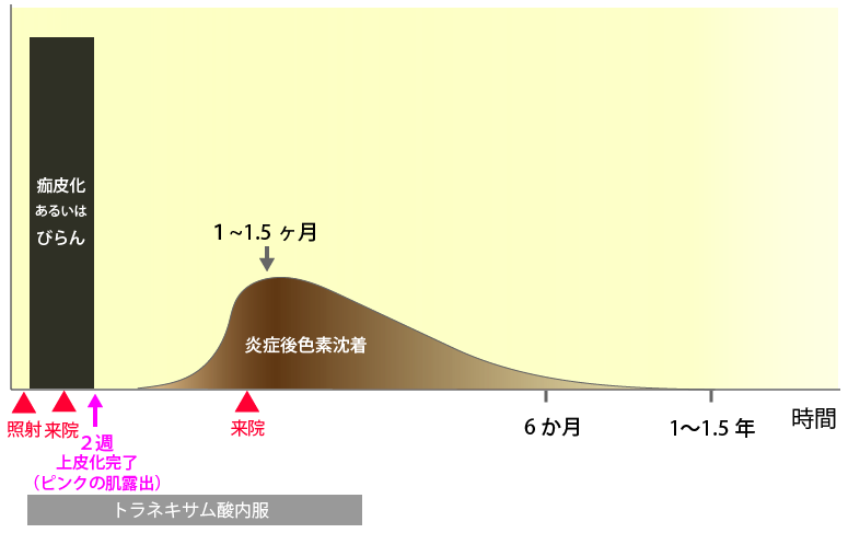 老人性色素斑治療後PIH