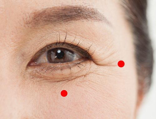 プロファイロの目じり注入点（目じり）