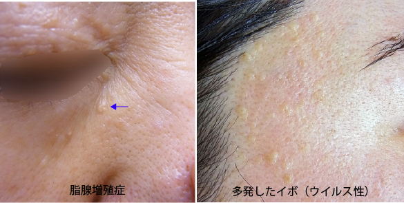 脂腺増殖症とウイルス性イボ