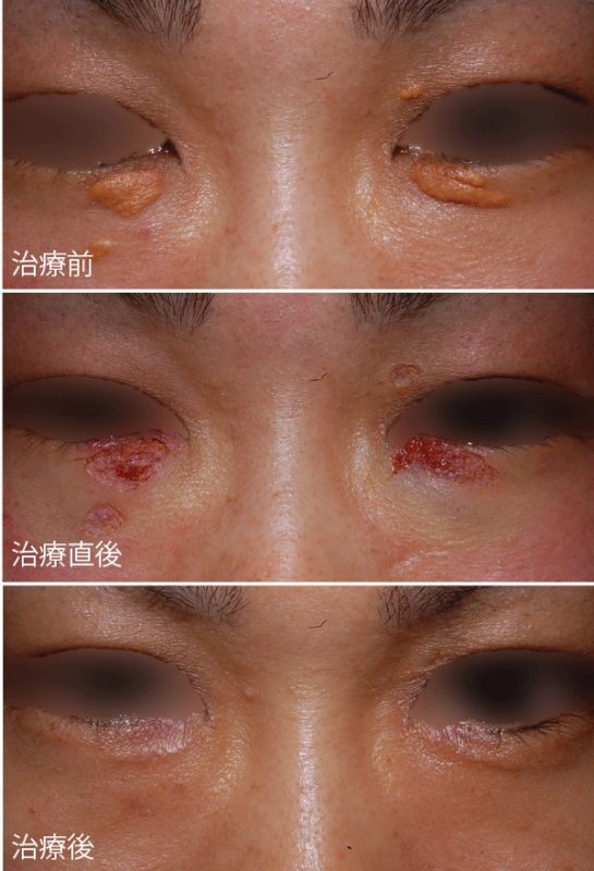 両側下眼瞼の黄色腫のをスキャナ付き炭酸ガスレーザーで治療した例