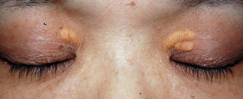 眼瞼黄色腫の写真