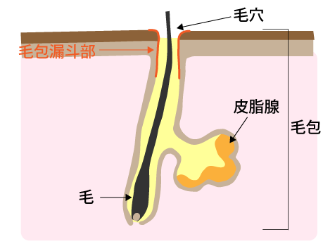 ニキビができるメカニズム1