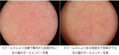 赤ら顔のダーモカメラ写真