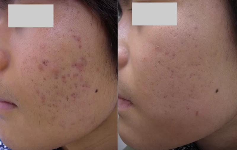 症例２ニキビ跡の赤みの治療例