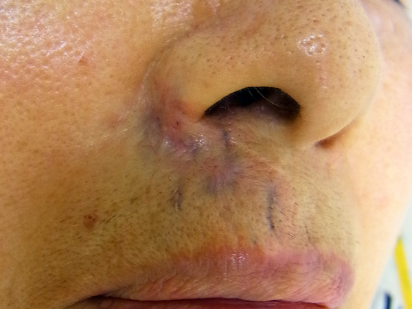 外傷性刺青の写真(顔鼻下)