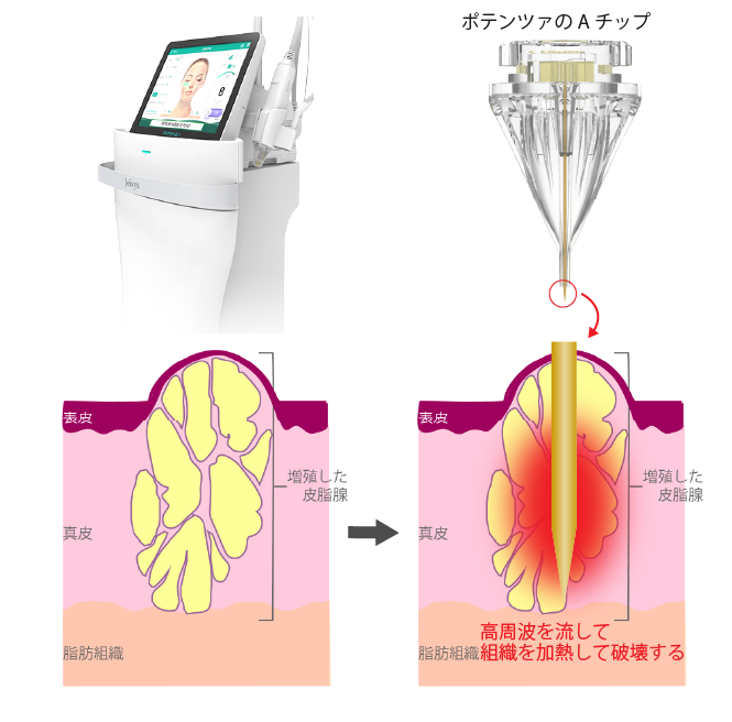 高周波を用いた脂腺増殖症の治療