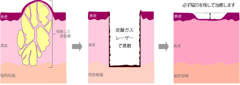 直径1㎜程度の脂腺増殖症のレーザー治療の手順のイラスト
