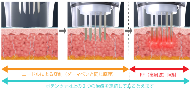 ポテンツァはダーマペンとRF（高周波）の双方の効果を持つ