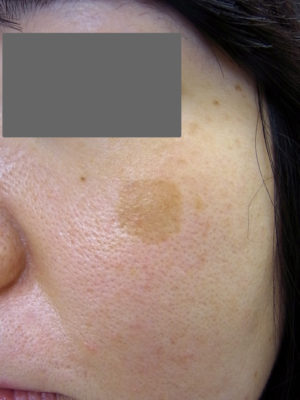 ３０歳代の女性のシミ（老人性色素斑）の写真
