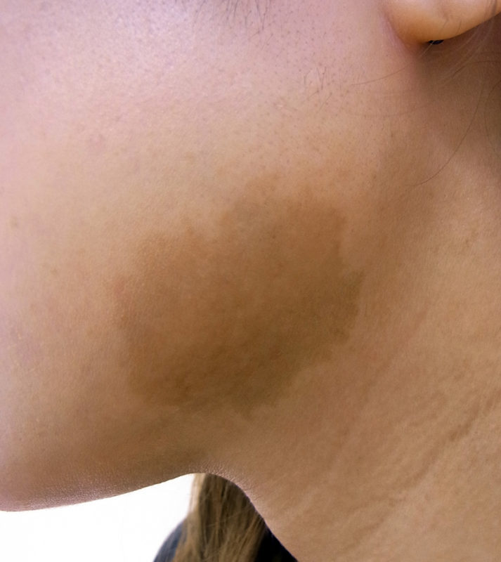 扁平母斑（顎部）