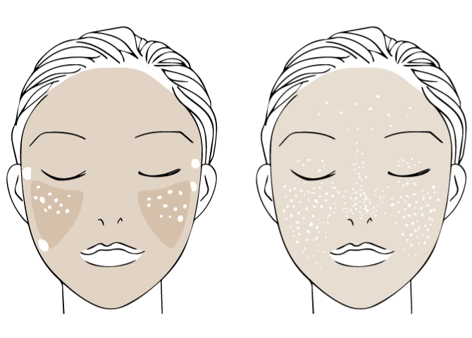 プレトリートメントなしに直接レーザー治療をおこなうとまだらになりやすい