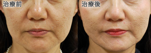 スレッドリフト症例写真