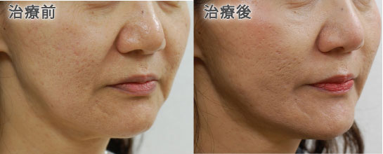 スレッドリフト症例写真