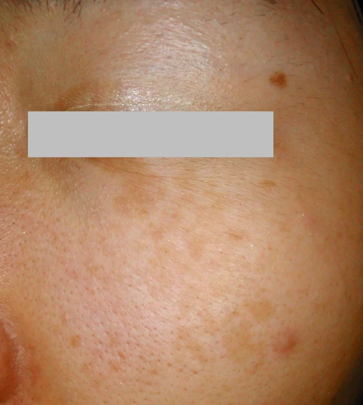 シミに似た太田母斑