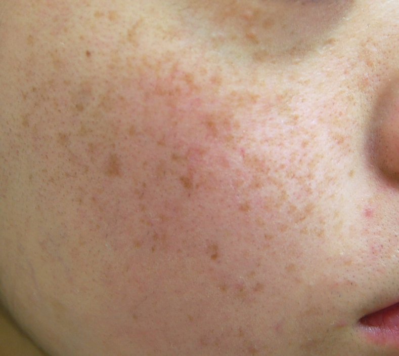 そばかす型の老人性色素斑の写真