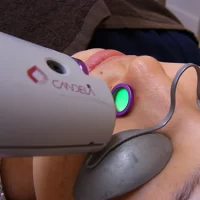 Vビームでの治療風景