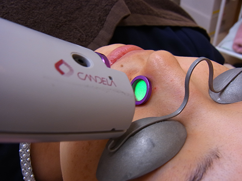 Vビーム治療風景