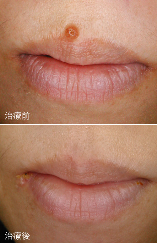 症例１の治療前後の写真
