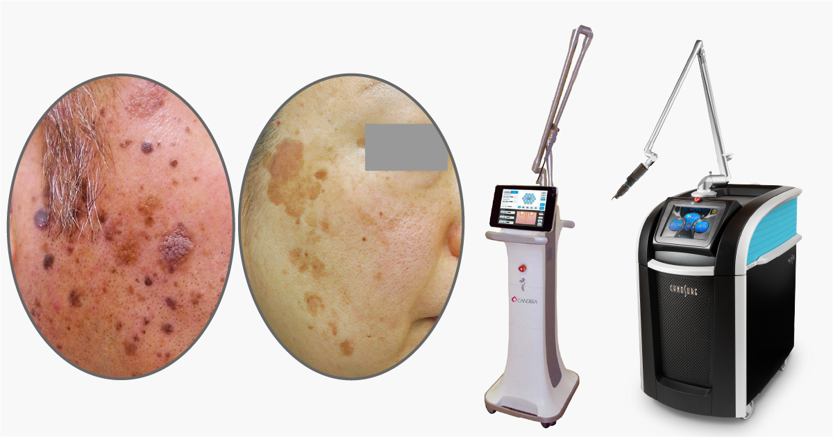 脂漏性角化症 （老人性イボ）｜東京新宿高田馬場の美容皮膚科・皮膚科